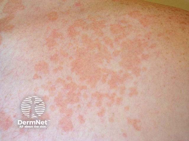 Разноцветный (отрубевидный) лишай (Pityriasis versicolor)
