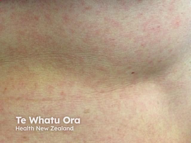 Инфекция, вызванная вирусом Зика: эритематозные пятна и папулы на туловище