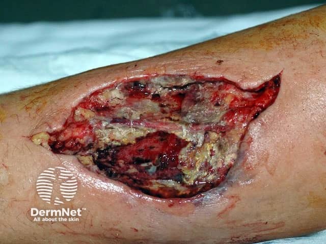 Мукормикоз в области хирургической раны