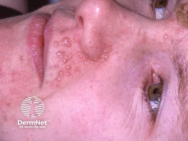 Множественные симметричные папулы цвета нормальной кожи диаметром 3–4 мм при семейной трихоэпителиоме