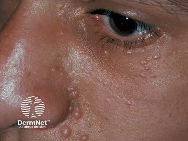 Папулы цвета нормальной кожи в периорбитальной и периносовой зонах при множественных трихоэпителиомах