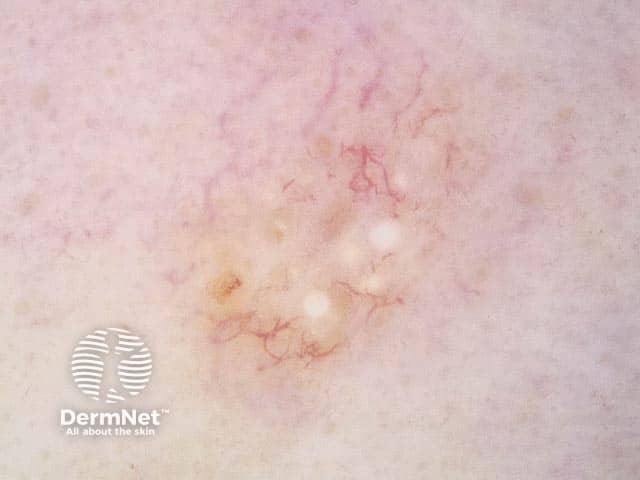 Дерматоскопия доброкачественной трихоэпителиомы: белые глыбкоподобные структуры, окруженные телеангиэктазиями