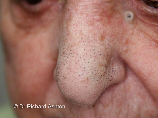 Шиповидный трихостаз на коже носа: множественные волоски, выходящие из одного фолликула