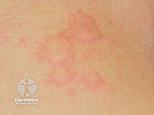 Крапивница: полициклические волдыри с периферическим венчиком