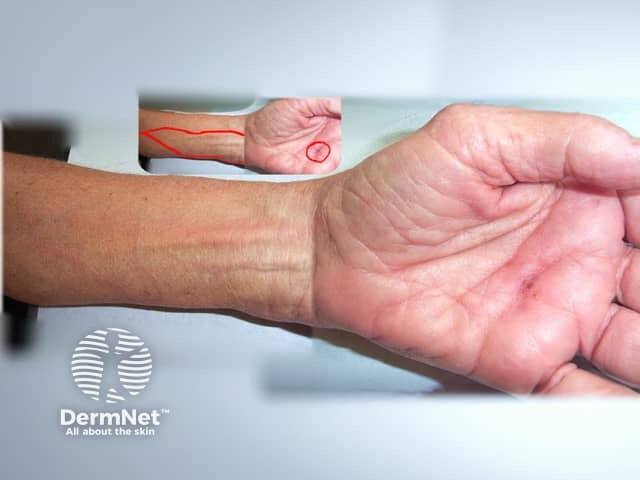 Лимфангит на фоне случайного травматического ранения. Предоставлено д-ром T. Evans.